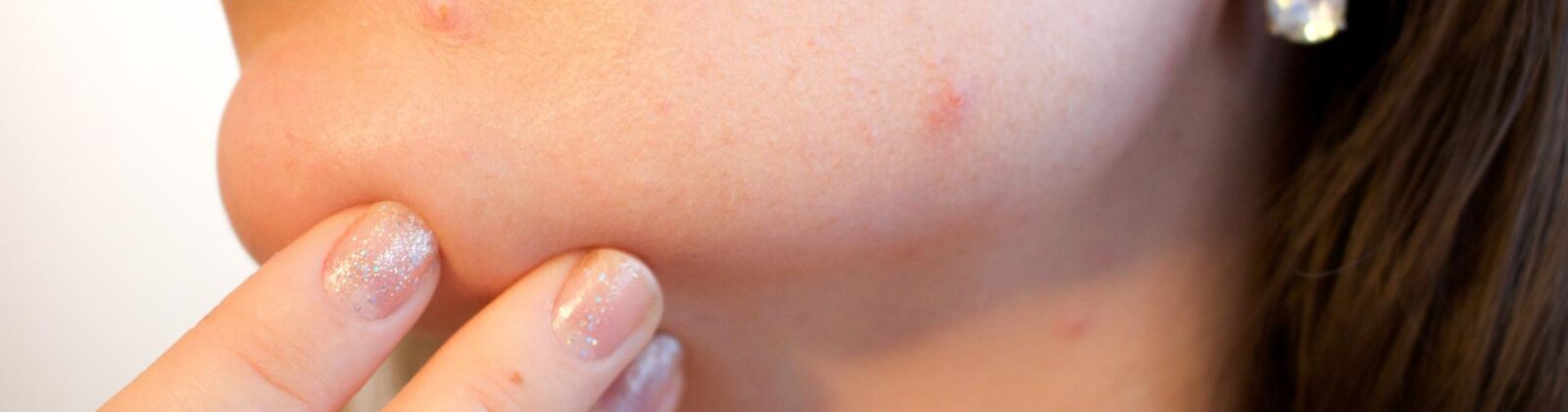 persons chin and lips showing acne. hand placed on chin